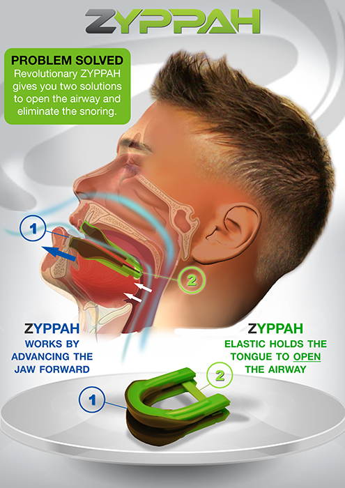 Zyppah Cons