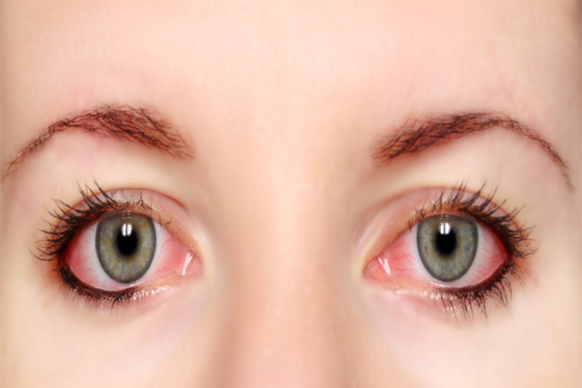 Top Effective Home Remedies for Red Eyes