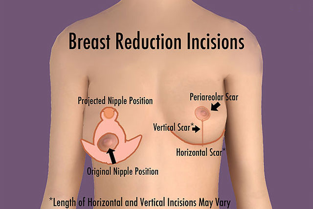 Breast Reduction Incisions