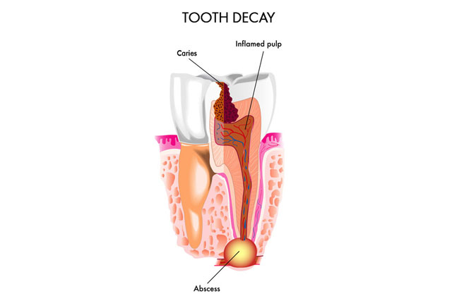 Abscessed Tooth